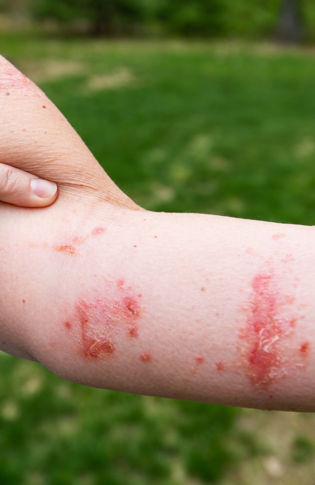 Urushiol from poison ivy can cause contact dermatitis rash.