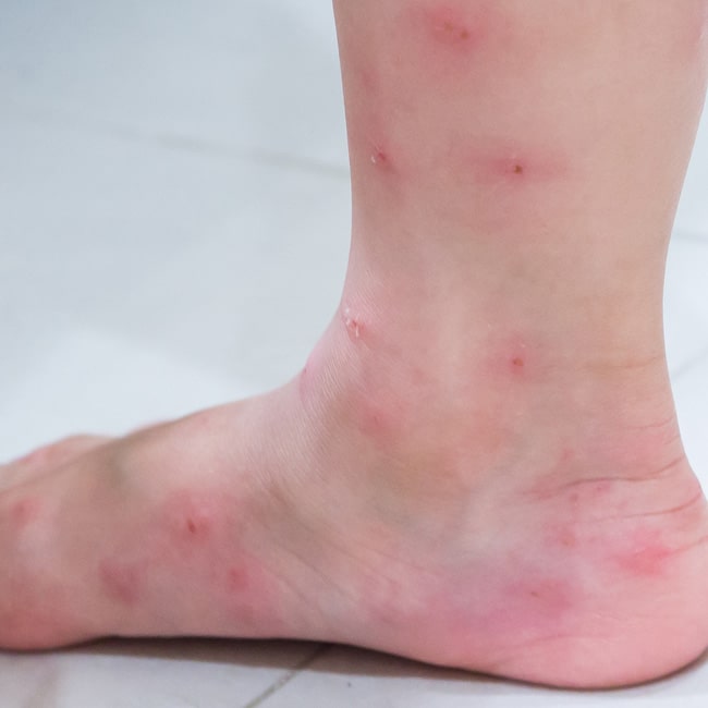 Ant bites can cause rashes
